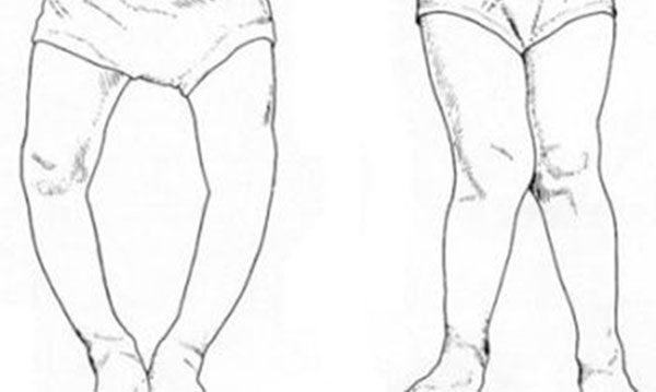 ���Ͳ�������֢״ ���Ͳ�С�����ߵı���